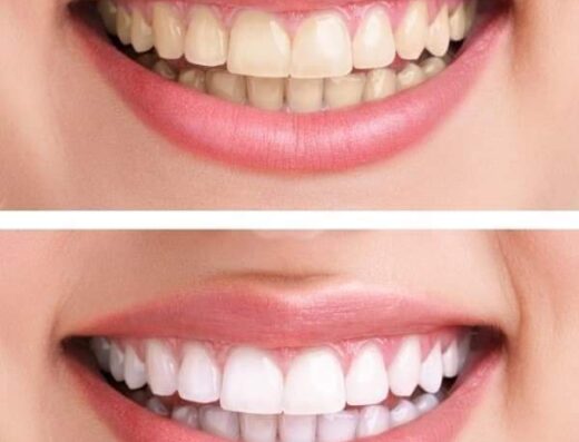 White Smile